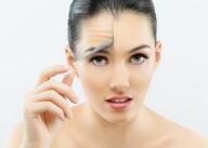 Nena despois do rexuvenecemento facial con láser fraccionado