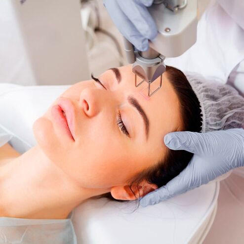 Procedemento de fototermólise para rexuvenecer a pel da cara