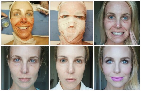 Etapas da cicatrización da pel facial despois do lifting de plasma exitoso