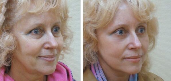Muller antes e despois do rexuvenecemento da pel facial por plasma