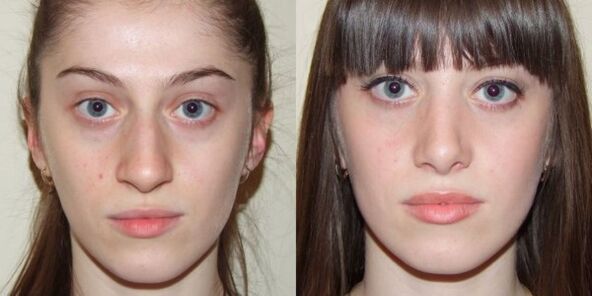 Nena antes e despois do rexuvenecemento da pel facial por plasma